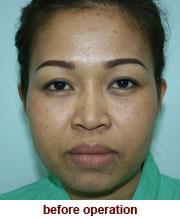 plastic_surgery_augmentation_rhinoplasty